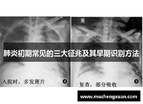 肺炎初期常见的三大征兆及其早期识别方法