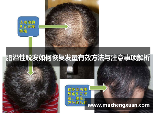 脂溢性脱发如何恢复发量有效方法与注意事项解析